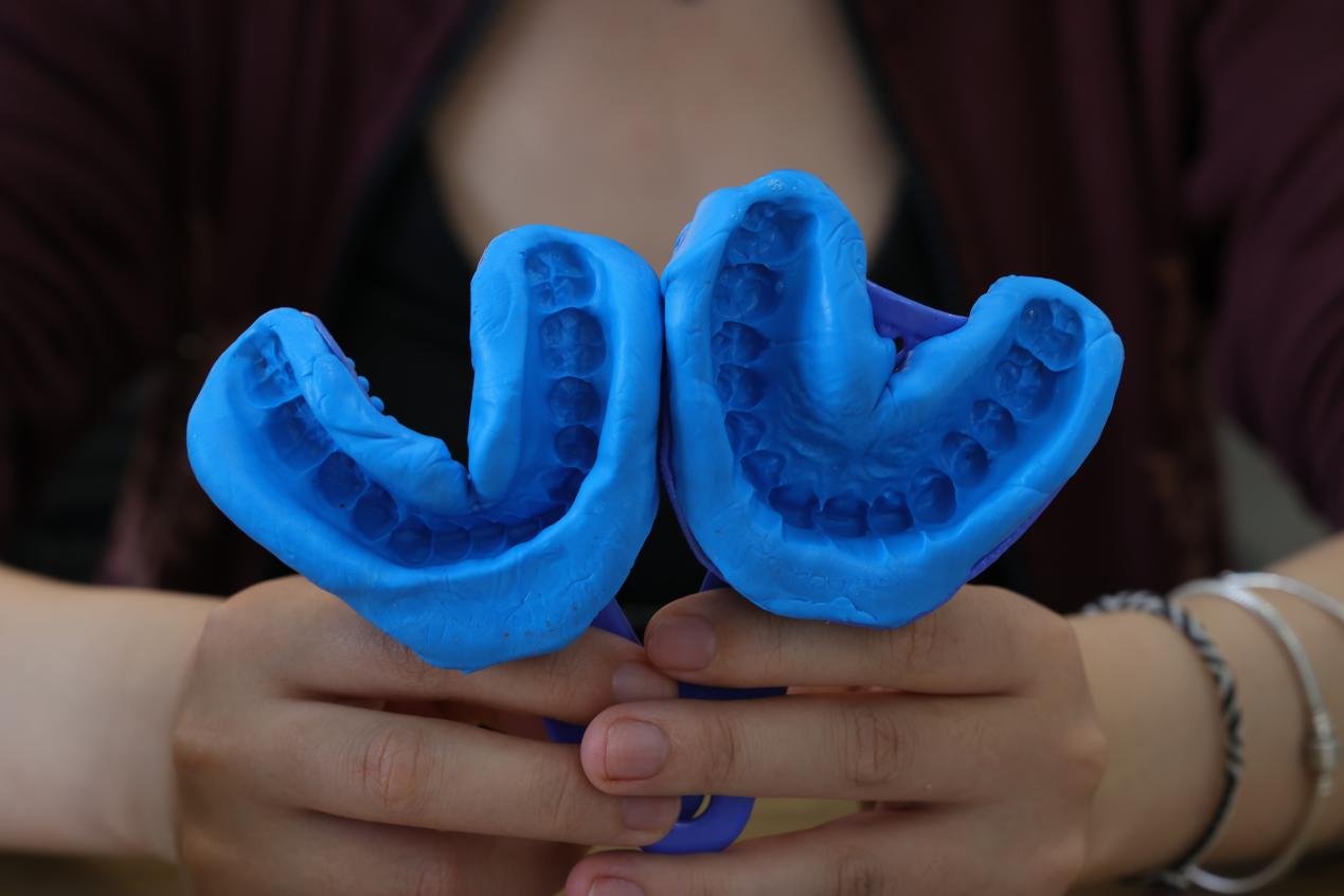Completed upper and lower dental impressions